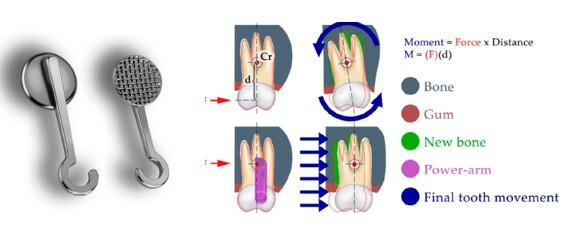Como o power arm se posiciona na superfície dentária para melhorar a movimentação do dente com alinhadores.